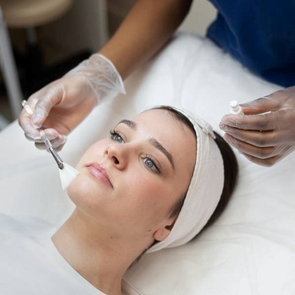 chemical peels for hyperpigmentation