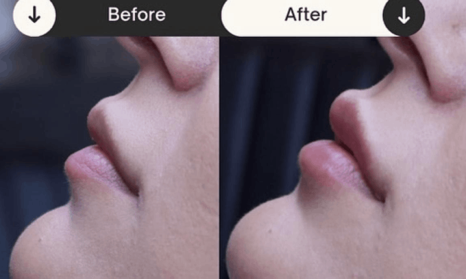 lip filler in Lewisville