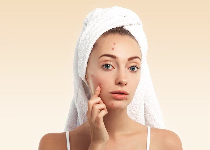 Acne Scars