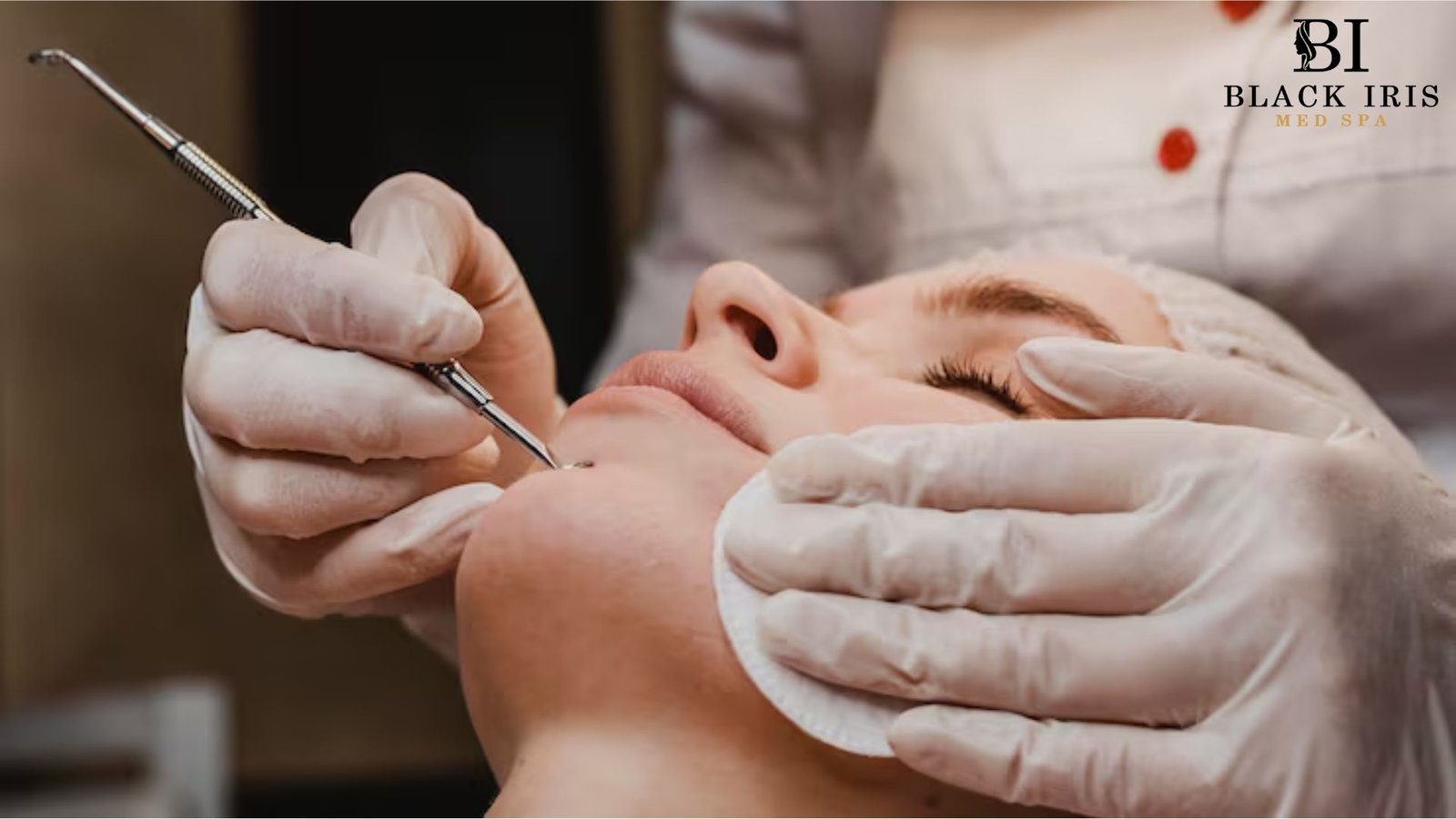 acne scars Lewisville