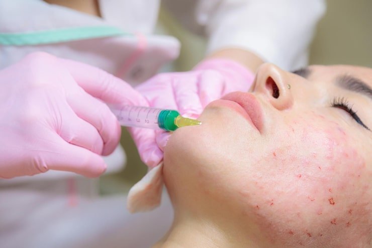 acne scarring treatment in Frisco