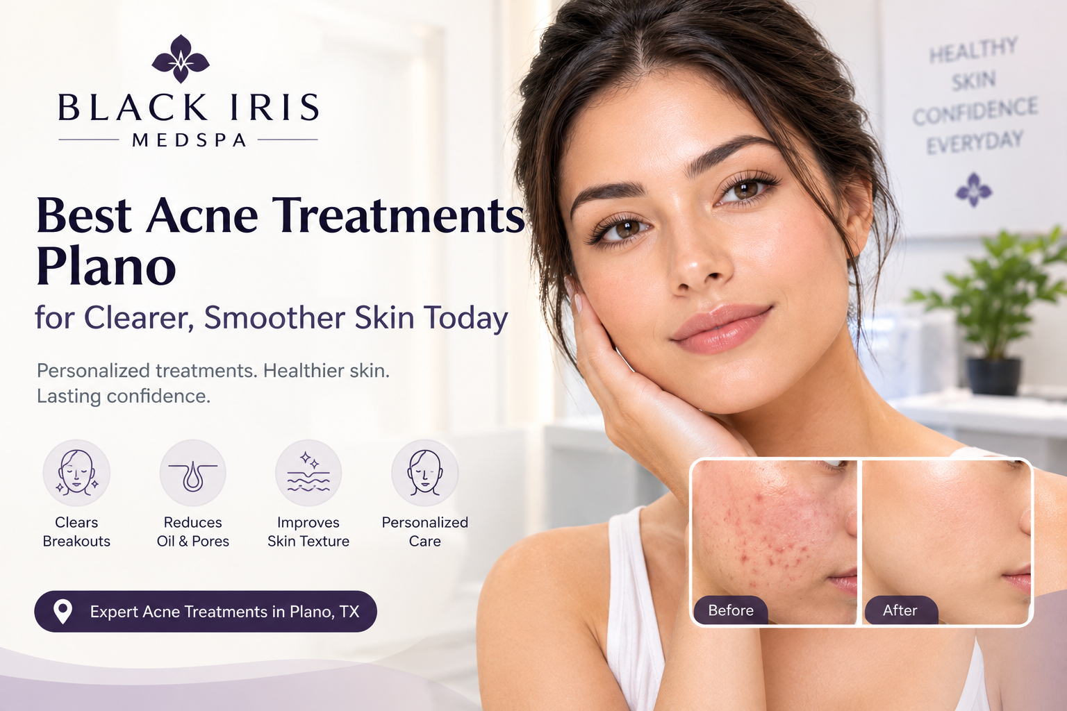Best Acne Treatments Plano for Clearer, Smoother Skin Today TX